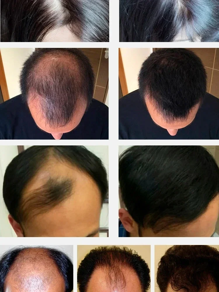 Unisex Saç Büyüme Yağı Saç Dökülmesi Tedavisi Hızlı Saç Büyüme Etkili Kellik Onarım Kalıtsal Doğum Sonrası Kaybı Görüntü 2